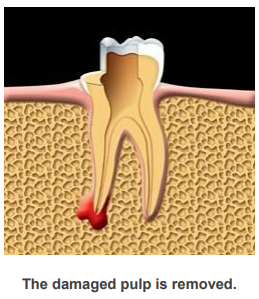 The damaged pulp is removed.