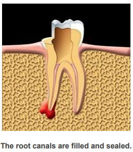 The root canals are filled and sealed.