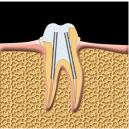 The tooth is prepared for a crown.Posts are used to help support the crown.